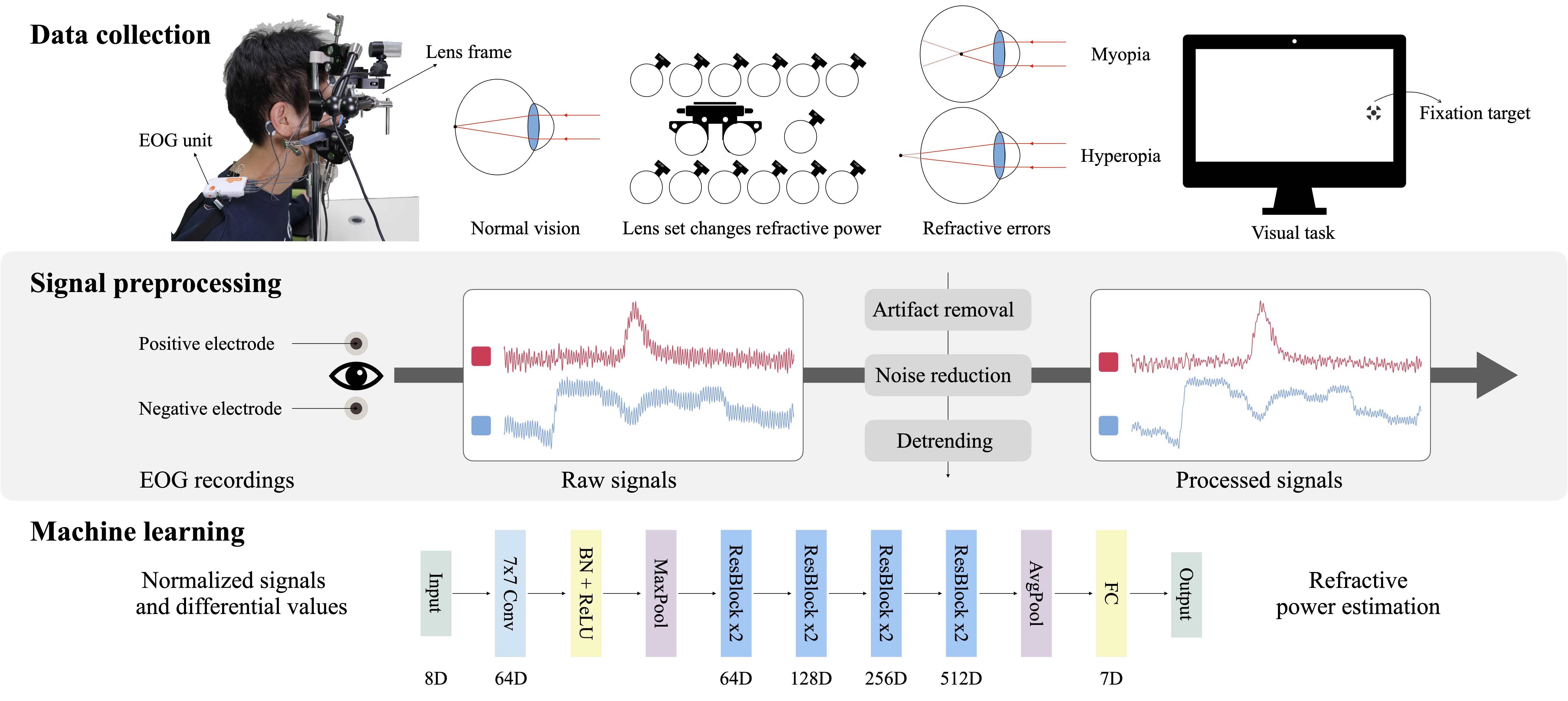 Electrooculography-Based Detection of Refractive Vision Problems